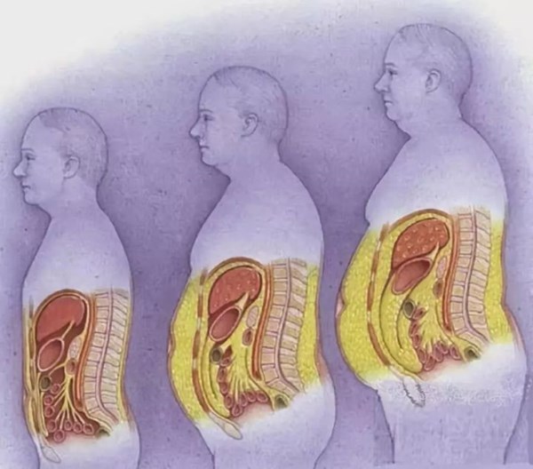 內(nèi)臟脂肪對比.jpg 內(nèi)臟脂肪對比.jpg